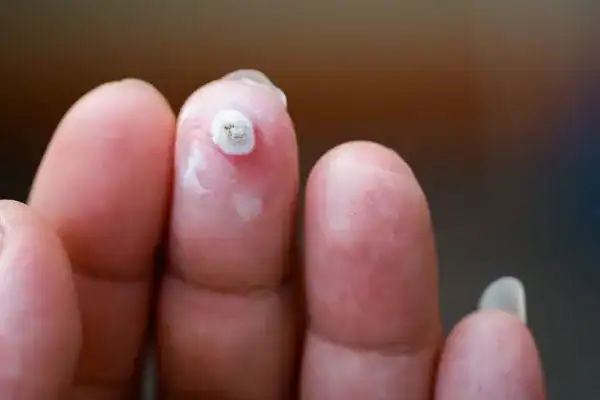 Image of white wart before cryopen treatment Tyne & Wear