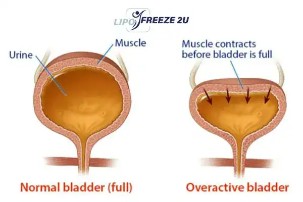 diagram of overactive bladder treatment Tyne & Wear