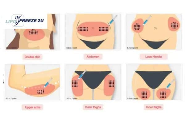 Benefits of Choosing Aqualyx for Fat Reduction Tyne & Wear