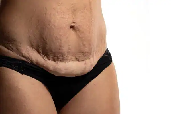 loose skin after weight loss injections Tyne & Wear
