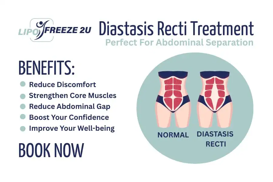 How Long Will It Take to See Improvements in Diastasis Recti Tyne & Wear