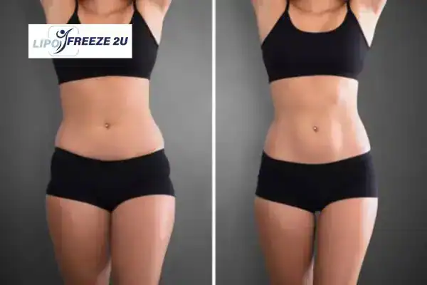 How Can LIPO FREEZE 2U Support Your Post-Pregnancy Body Recovery Tyne & Wear?