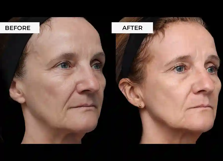 How Many RF Microneedling Sessions Will You Need to See a Difference Tyne & Wear?