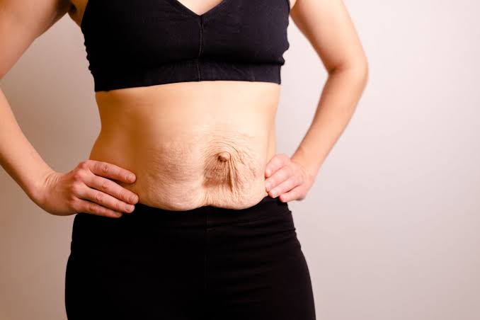Is Surgery Really the Only Way to Repair Diastasis Recti Tyne & Wear?